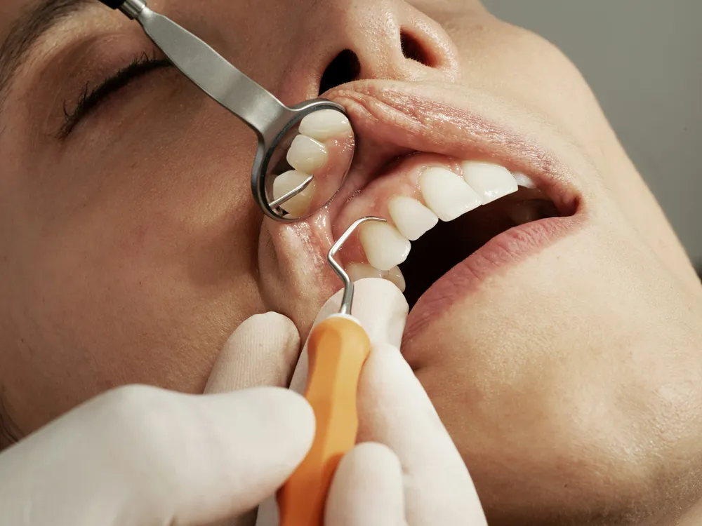 Teeth after composite dental bonding