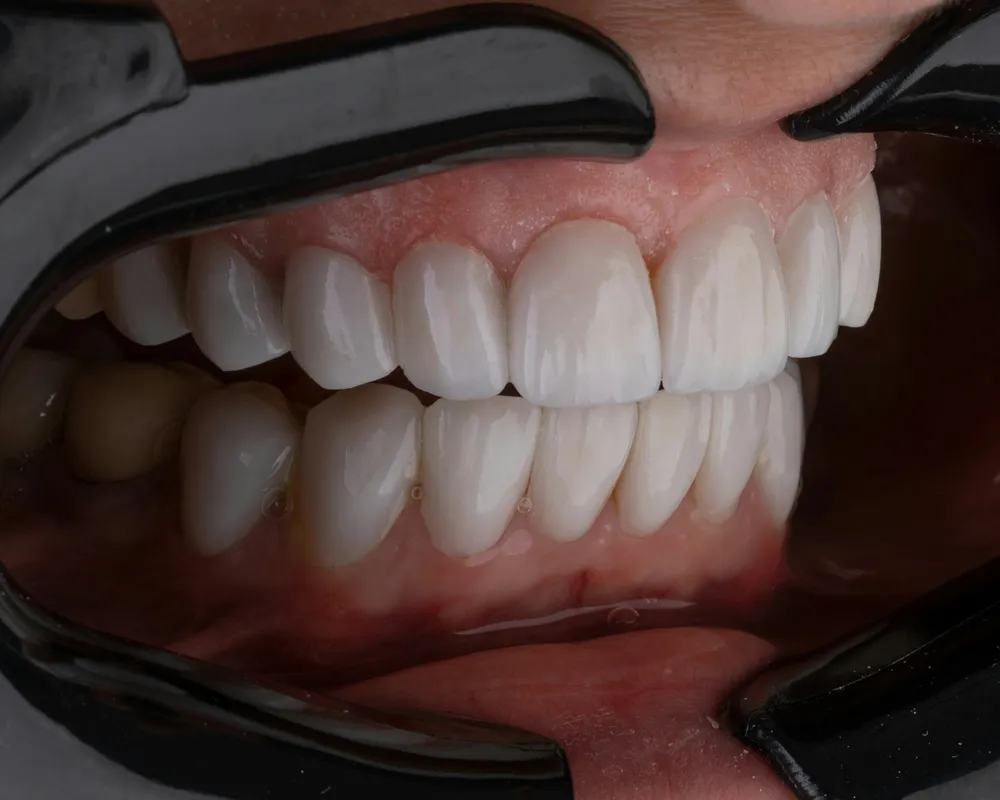Dental laser handpiece in use
