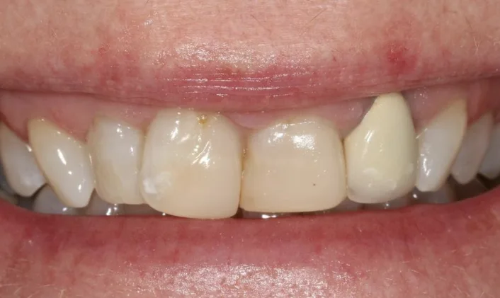 Before: Whitening to lift long-standing staining.