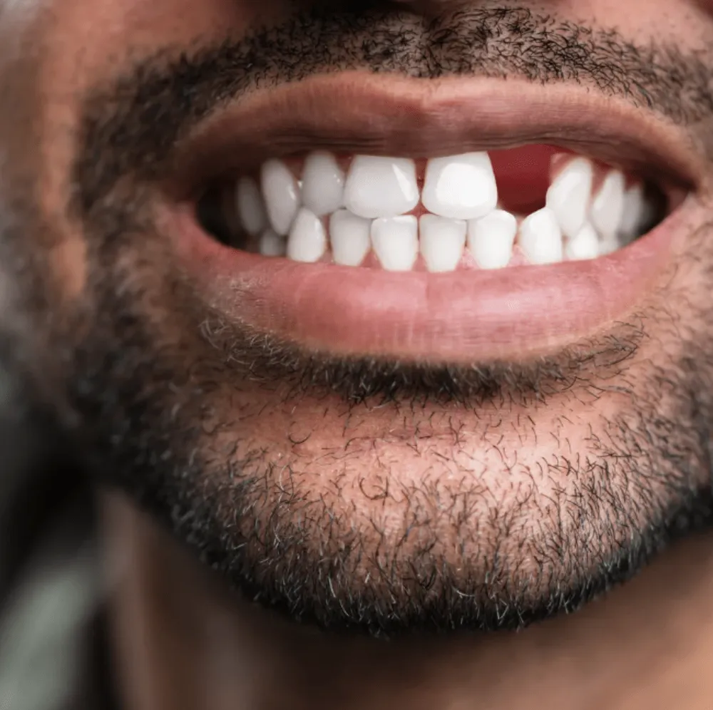 Smile with a gap from a missing tooth