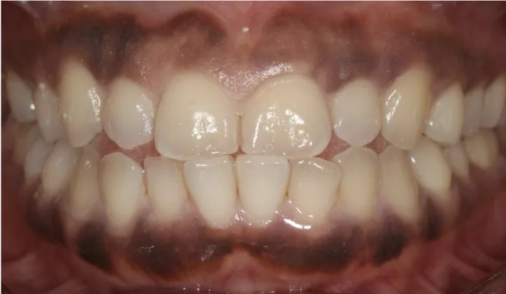 Before: Laser gum depigmentation to even out darker gum colour.