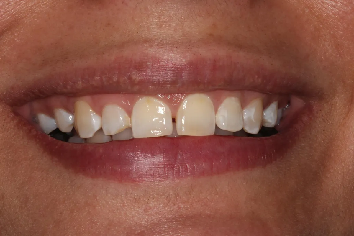 Before: Bonding to restore worn, uneven edges.