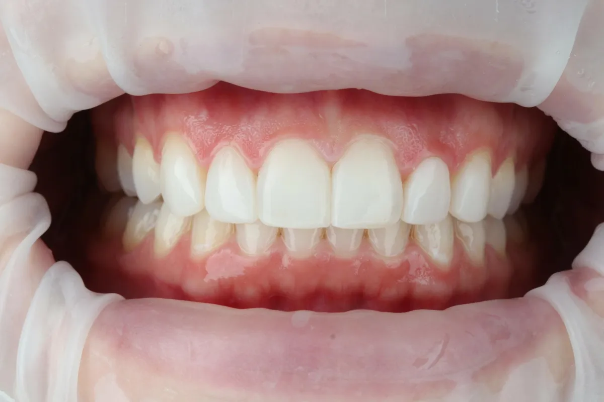 After: Composite bonding to reshape and even out the front teeth.