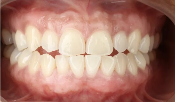 After: Laser gum depigmentation to even out darker gum colour.