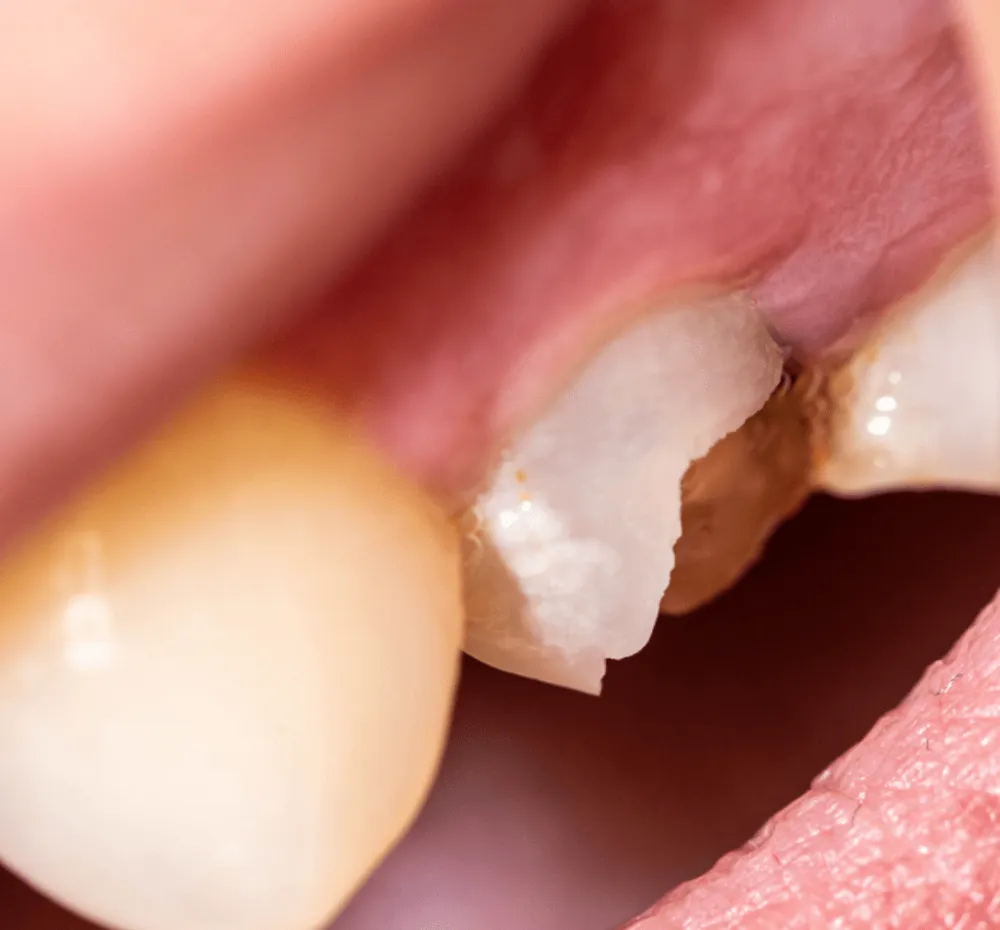 Chipped front tooth before repair
