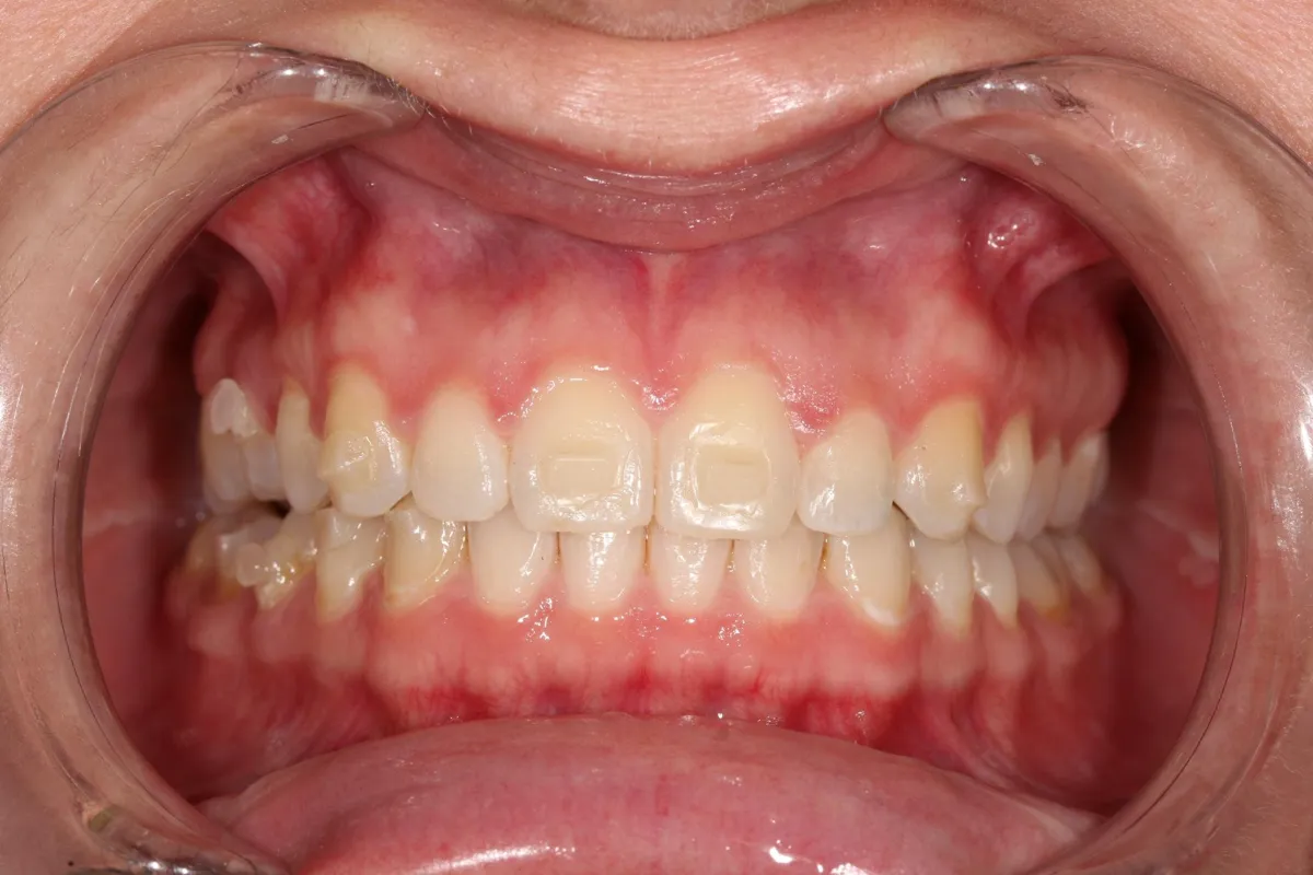 Before: Composite bonding to reshape and even out the front teeth.