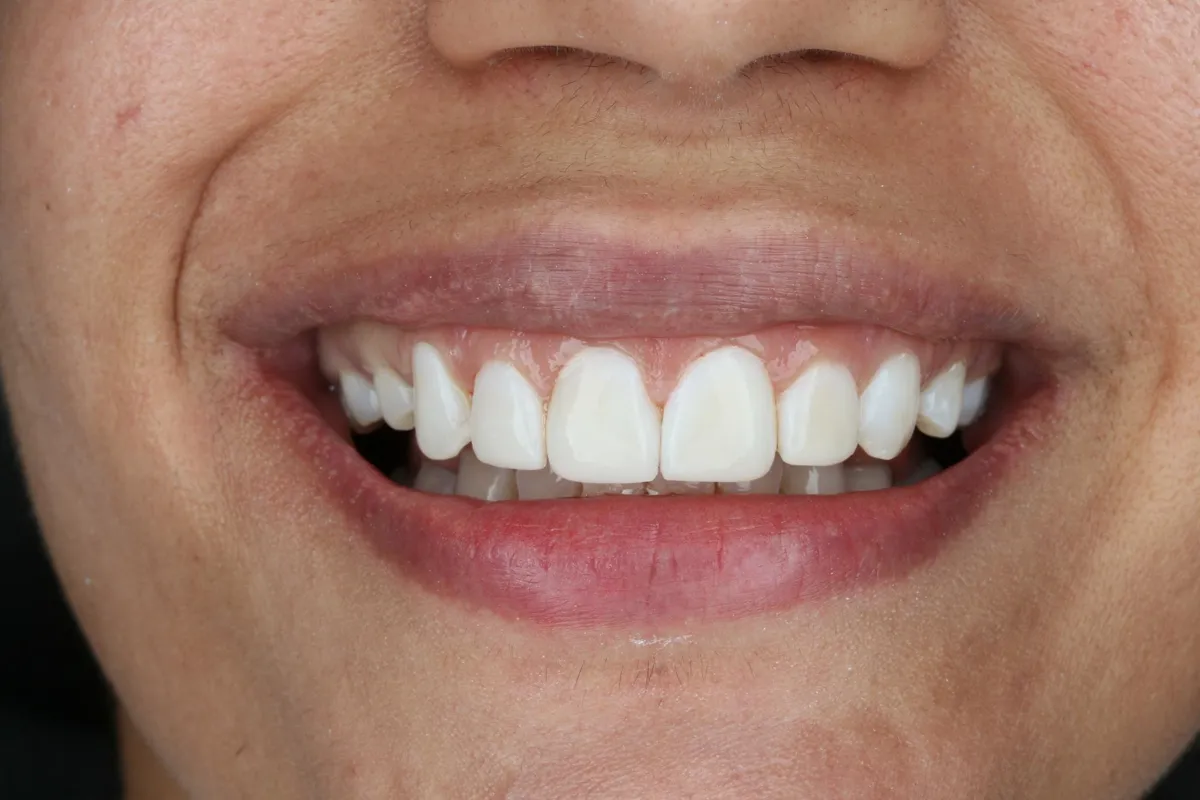 After: Bonding to restore worn, uneven edges.