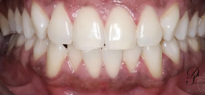 After: Professional in-chair whitening.