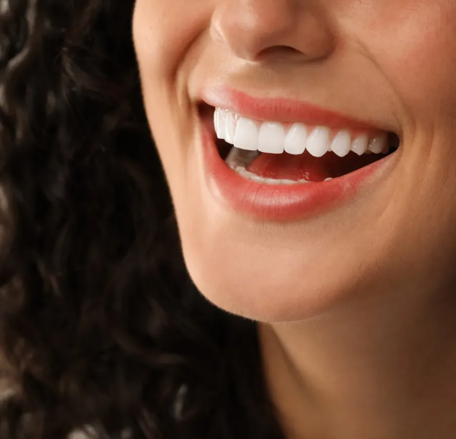 Porcelain veneers on a smile