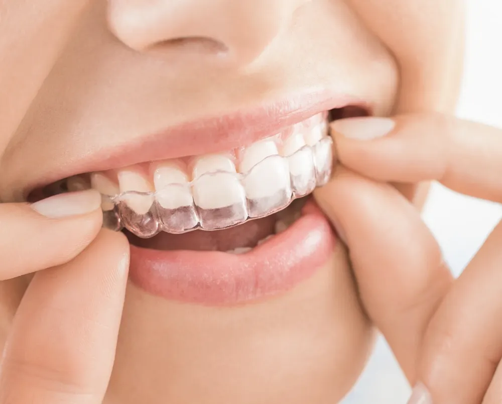 Clear aligner tray