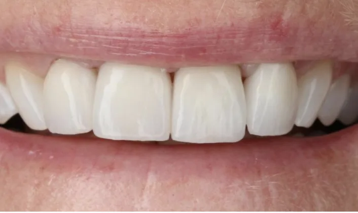 After: Whitening to lift long-standing staining.