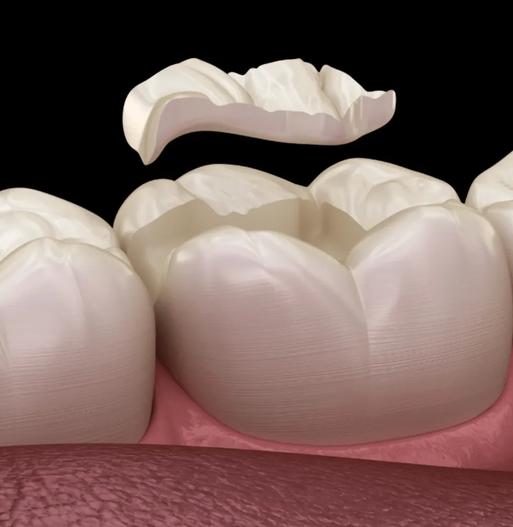 Ceramic onlay restoration