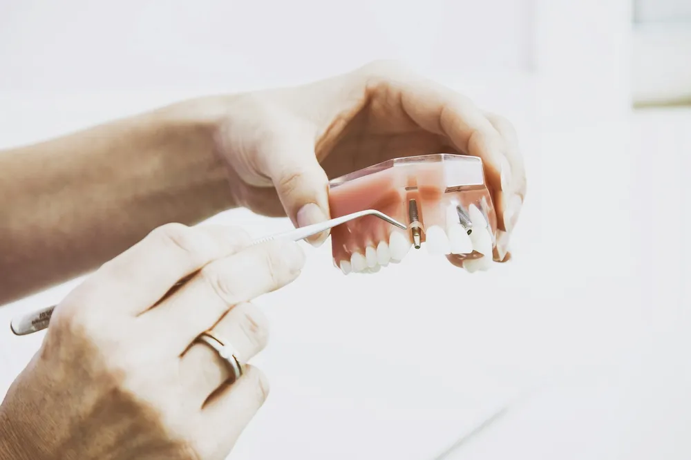 Dental implant model