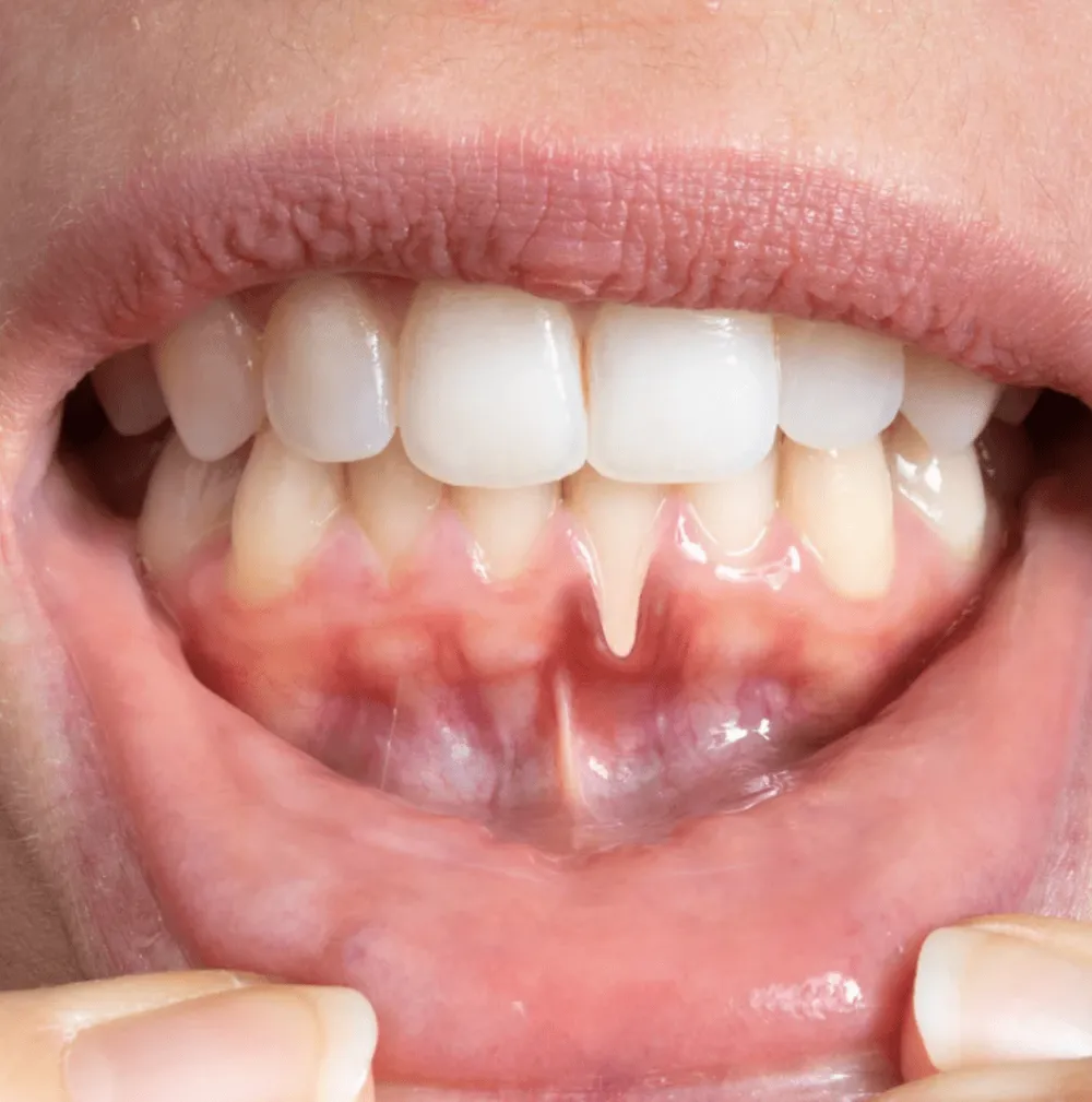 Gums after laser depigmentation