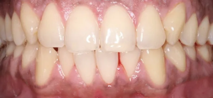 Before: Professional in-chair whitening.