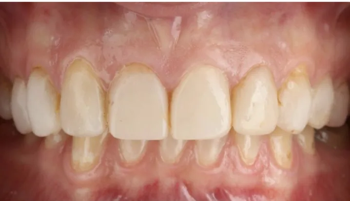 Before: Professional whitening for a brighter shade.