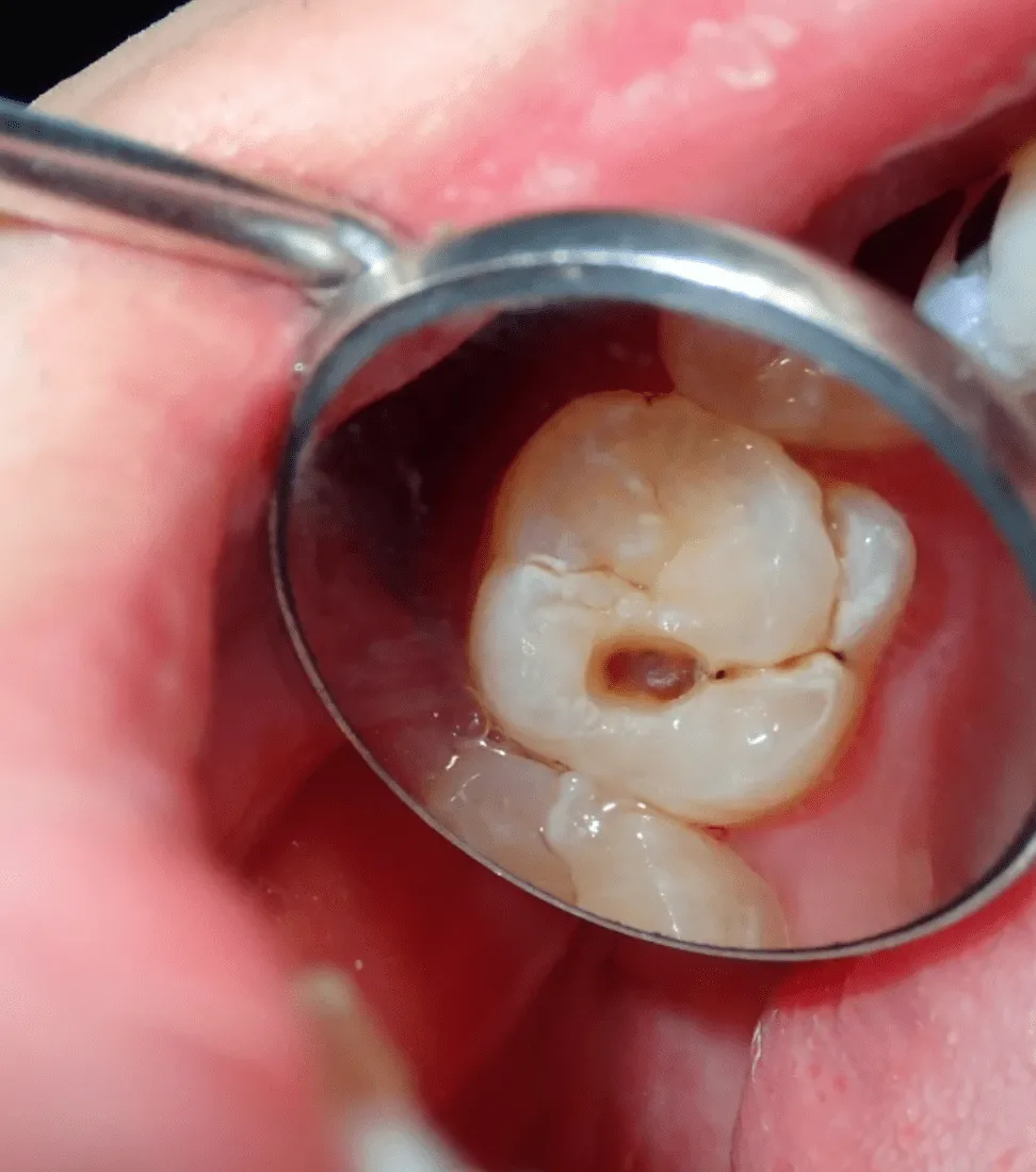 Close-up of a tooth-coloured filling